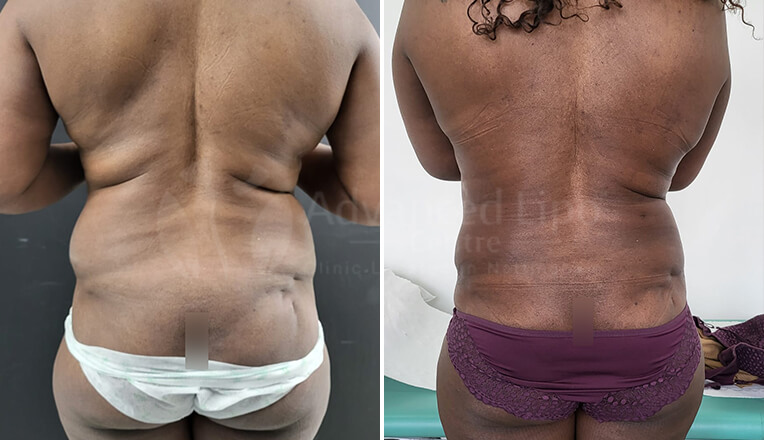 back vaser liposuction before and after dr kam singh-1