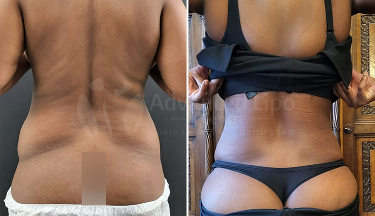 back vaser liposuction before and after dr kam singh