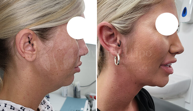 facial liposuction before and after by dr kam singh-1