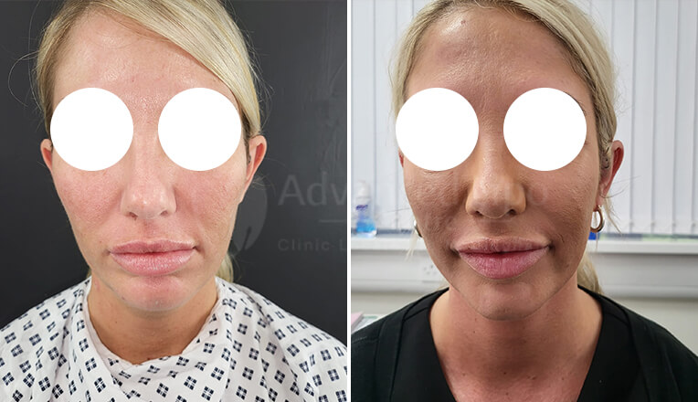 facial liposuction before and after by dr kam singh-3