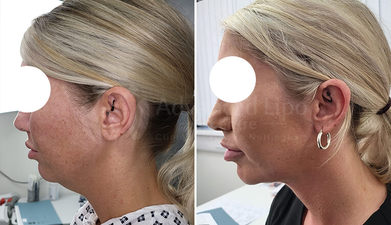 facial liposuction before and after by dr kam singh