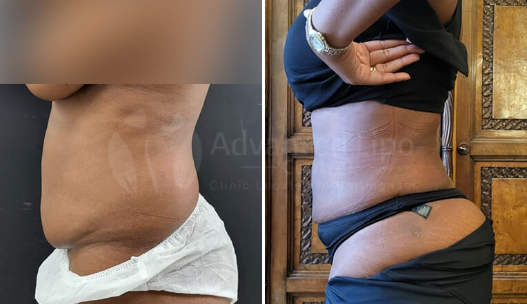 vaser liposuction before and after by dr kam singh-1