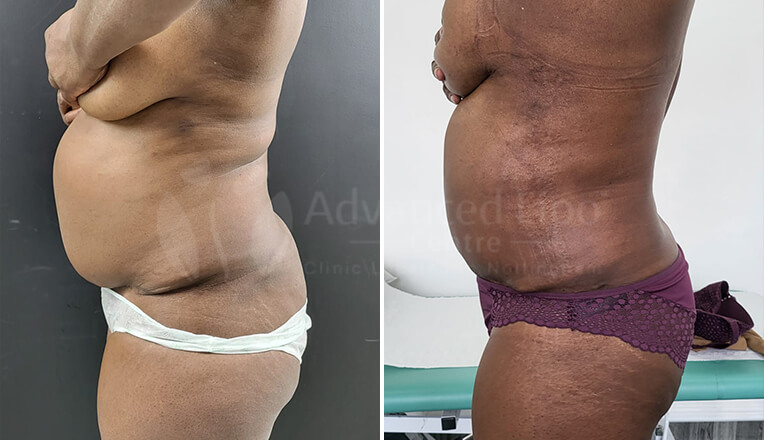 vaser liposuction before and after by dr kam singh-2