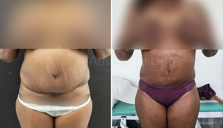 vaser liposuction before and after by dr kam singh-3