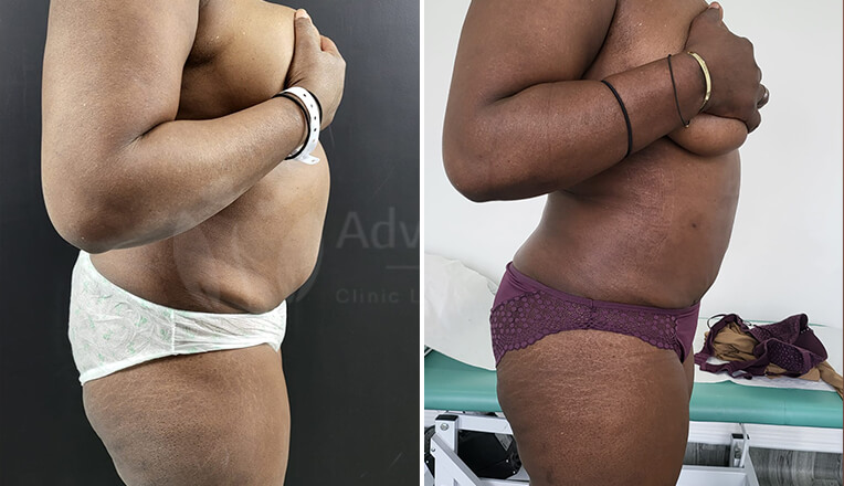 vaser liposuction before and after by dr kam singh-4